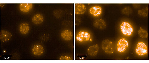 Neuroblastomzellen unter dem Mikroskop. Die Färbung stellt DNA-Schäden dar, je intensiver, desto stärker und gefährlicher der Schaden. Zellen auf der rechten Seite haben kein RNA-Exosom und sind daher wesentlich anfälliger für solche Schäden.