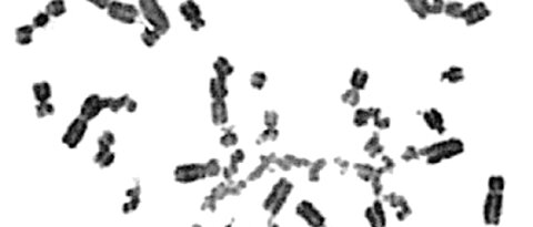 Chromosomen von Kindern, bei denen beide Kopien des FANCN-Gens Mutationen tragen. Durch die Schäden kommt es zu unzähligen Chromosomenbrüchen. Das Ergebnis, eine Chromosomenfragmentierung, ist im unteren Teil des Bildes deutlich zu sehen. Abbildung aus