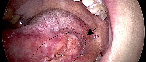 Solider Tumor (Plattenepithelkarzinom) am Zungengrund eines Patienten mit Fanconi-Anämie.
