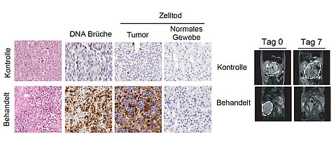 Das Konzept der zwei Züge auf einem Gleis in der biologischen Realität. Links sieht man mikroskopische Bilder von Tumor- und Normalgewebe, die zeigen, dass die Auslösung von Kollisionen zwischen dem Ablesen und der Verdoppelung der DNA zu Chrosomosomenbrüchen und Tod des Tumorgewebes führt, aber keine Effekte auf das benachbarte Normalgewebe hat. Rechts sind radiologische Aufnahmen, die zeigen, dass der Tumor nach relativ kurzer Behandlung zusammenbricht. Die Aufnahmen zeigen Neuroblastome. 